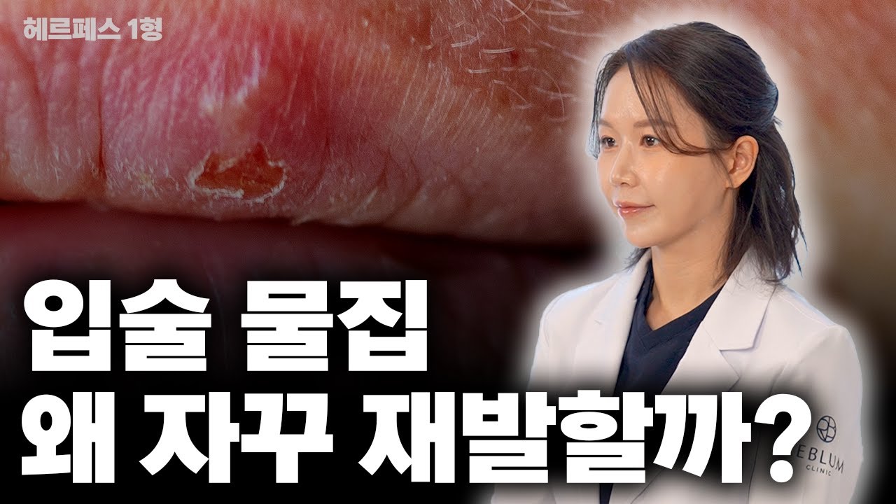 입술 포진, 단순히 피곤해서 생기는 걸까?