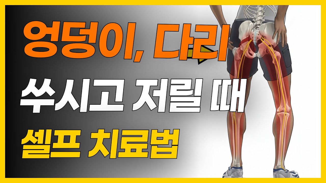 엉덩이 쑤시거나 다리가 저릴 때 직빵 치료법 | 허리디스크? 이상근증후군?