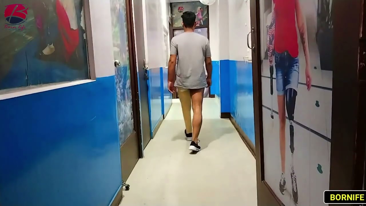 Natural Walk & Comfortable  walk with  Above knee Prosthetic Leg|| Bornlife Artificial Limbs Center