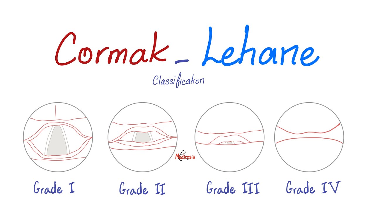 Cormak-Lehane Classification (Grades) for Airway Management and Endotracheal Intubation - Anesthesia