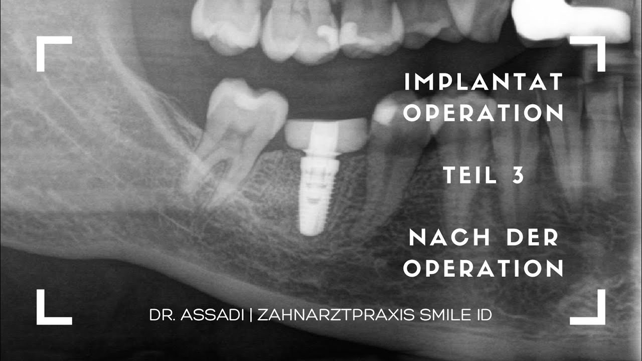 Implantat Operation Teil 3 - Nach der Zahn Implantation