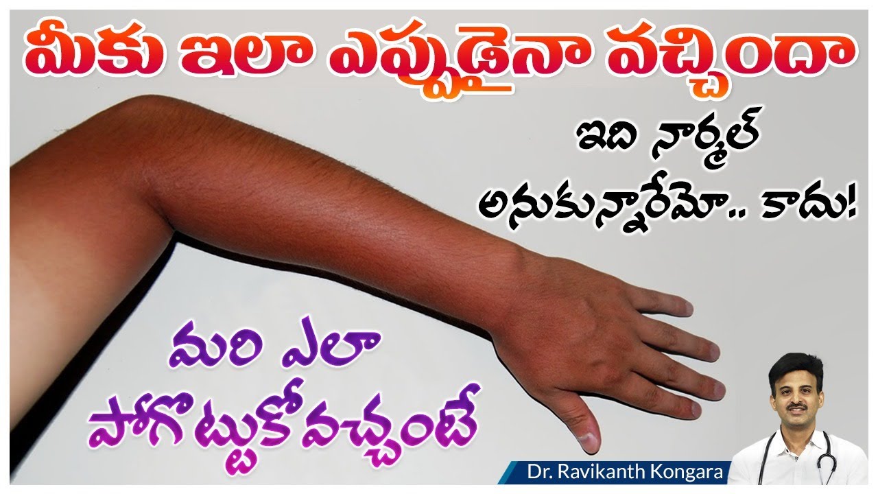 Causes of Sun Tan | Black Spots | B3 Vitamin Deficiency | Reduces Weight | Dr. Ravikanth Kongara