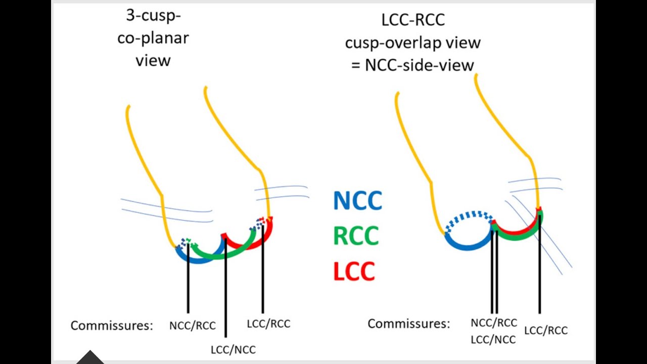 Jenavalve for Severe Aortic Regurgitation (AR): An elegant transcatheter solution (TAVI)