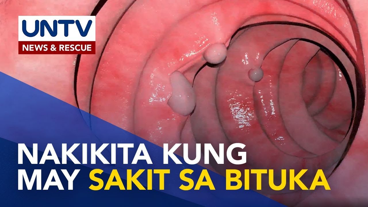 COLONOSCOPY: Ano ito at sino ang dapat sumailalim sa ganitong procedure? | Now You Know