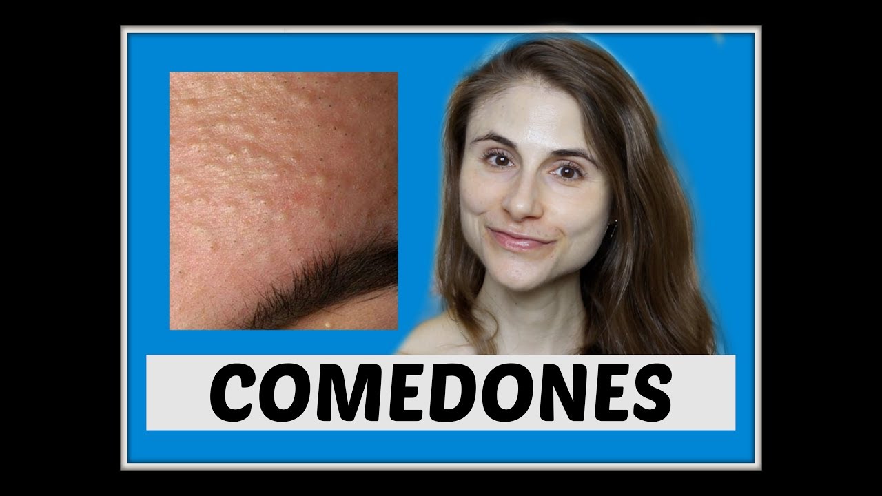 CLOSED COMEDONES: Q&A WITH DERMATOLOGIST DR DRAY
