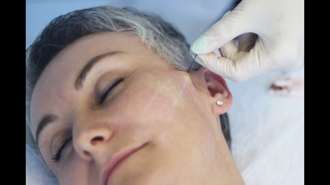 This Is Beauty | PDO Threading | Non-surgical lift that boost collagen and elastin
