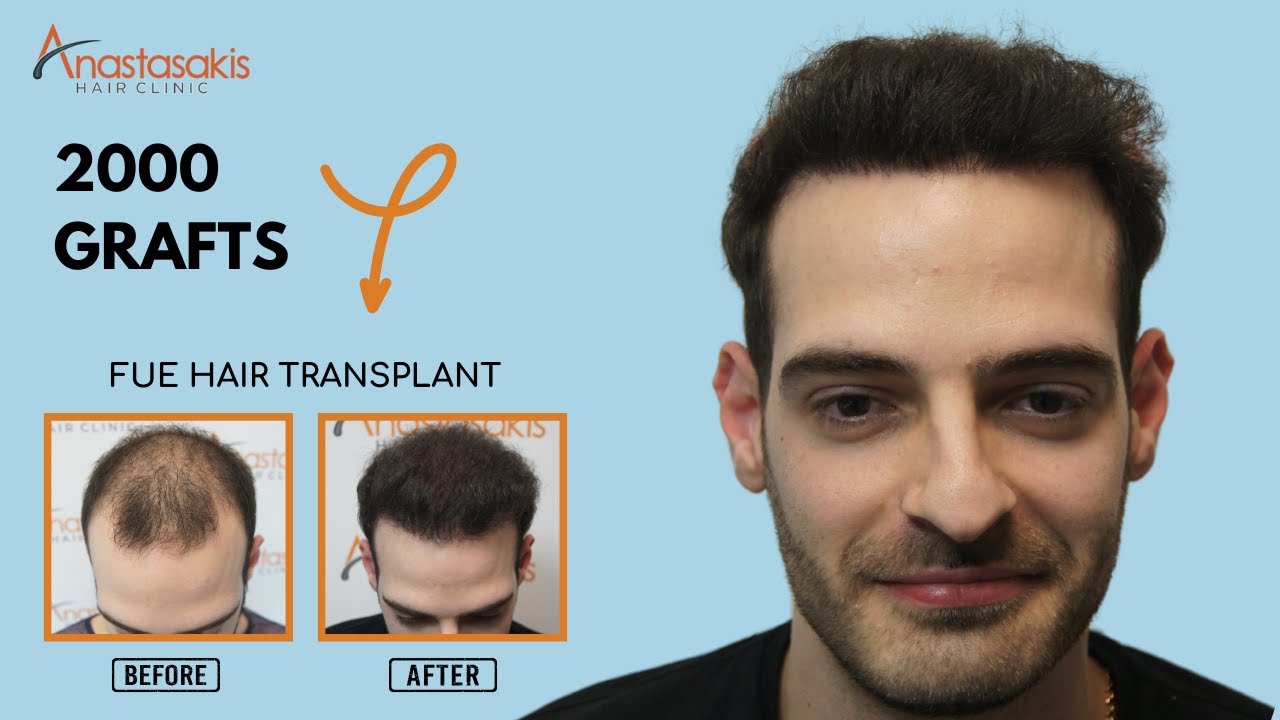 🎥 12-Month Post-Hair Transplant Check-Up | 2000 Grafts FUE | Anastasakis Hair Clinic 🌟 Case #294