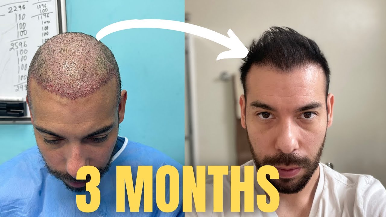 3 Month Hair Transplant Update 4,000 Grafts FUE (9k Total)