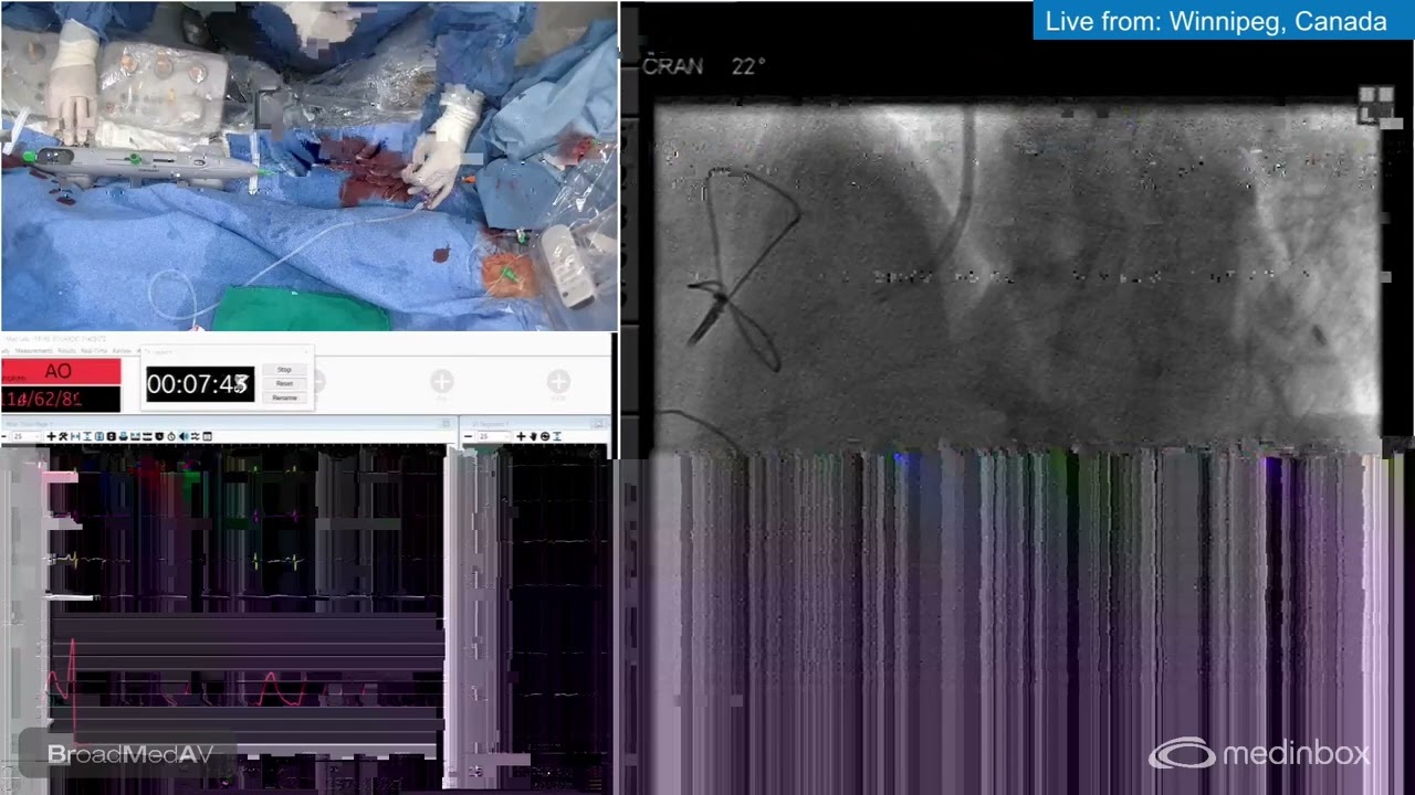 Upfront Orbital Atherectomy With PCI Guided by OCT