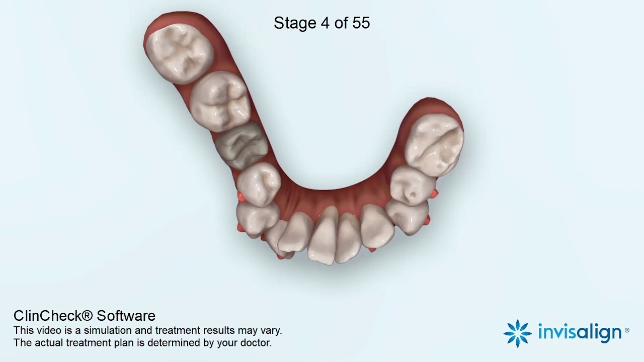 Winner!! Invisalign 2020 Case Shoot Out