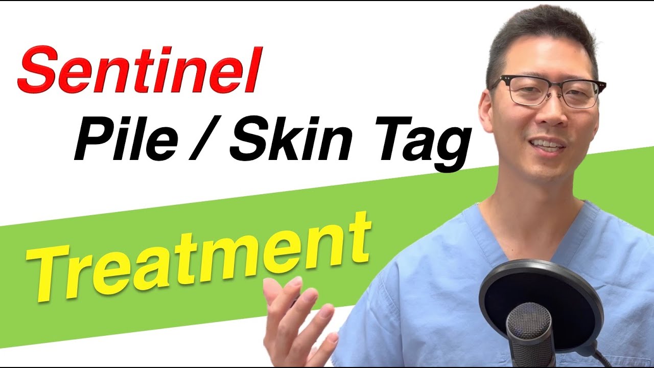 Can I remove Sentinel Piles or Sentinel Skin Tags? | Dr. Chung tells you the options!