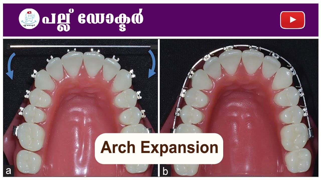 എന്താണ് Arch Expansion ...