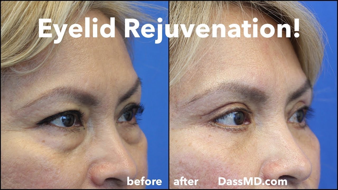 Eyelid Lift Beverly Hills Plastic Surgeon Shows Eyelid Surgery Results