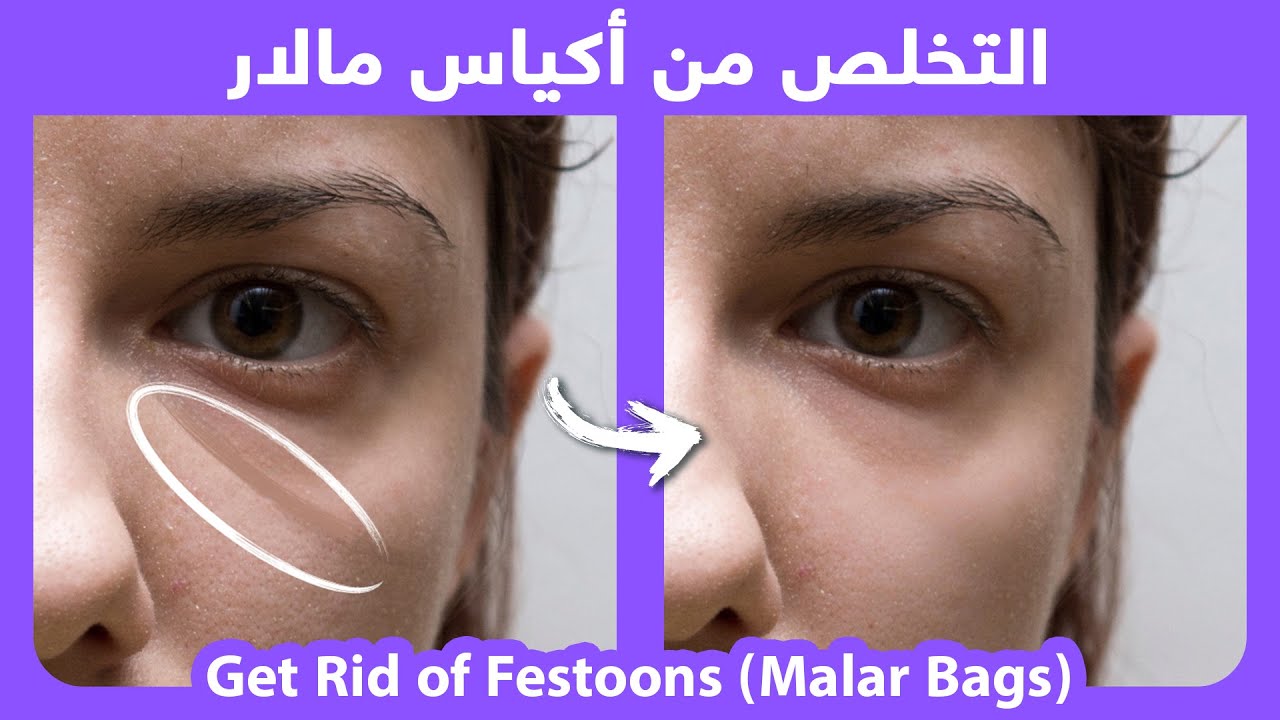 How to naturally get rid of Malar bags, or Festoons |  التخلص من أكياس مالار