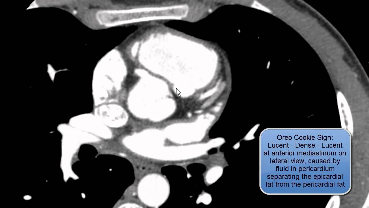 Pericardium on Axial CTA