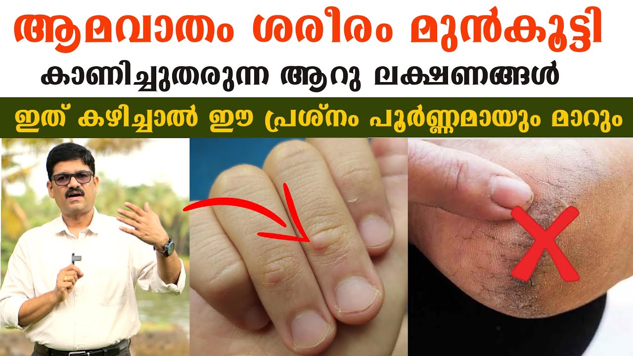 ആമവാതം ശരീരംമുൻകൂട്ടി കാണിച്ചുതരുന്ന 6 ലക്ഷണങ്ങൾ ഇത് കഴിച്ചാൽ ഈ പ്രശ്നം പൂർണ്ണമായും മാറും/Dr Shimji