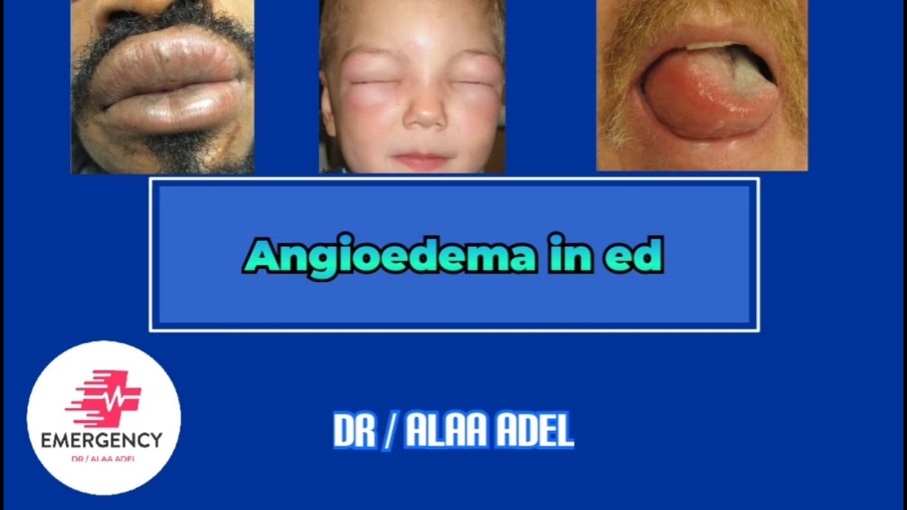 Angioedema in ed