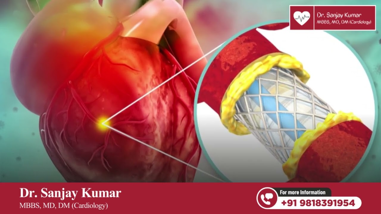 How long does a stent really last?
