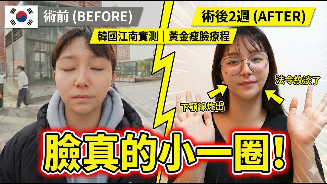 實測!只需1小時臉直接小一圈？韓國最新「黃金瘦臉療程」太誇張！原本的雙下巴竟變V字線？