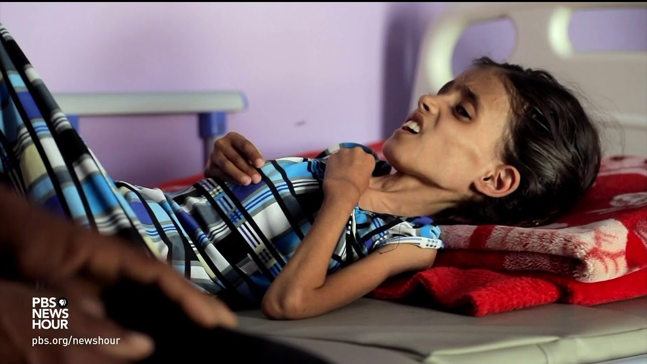 Yemen's spiraling hunger crisis is a man-made disaster