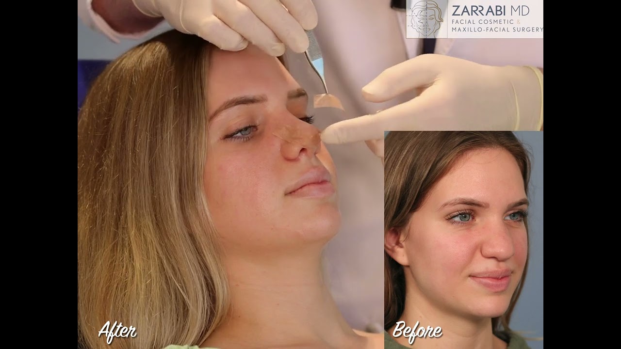 Closed Piezo Rhinoplasty