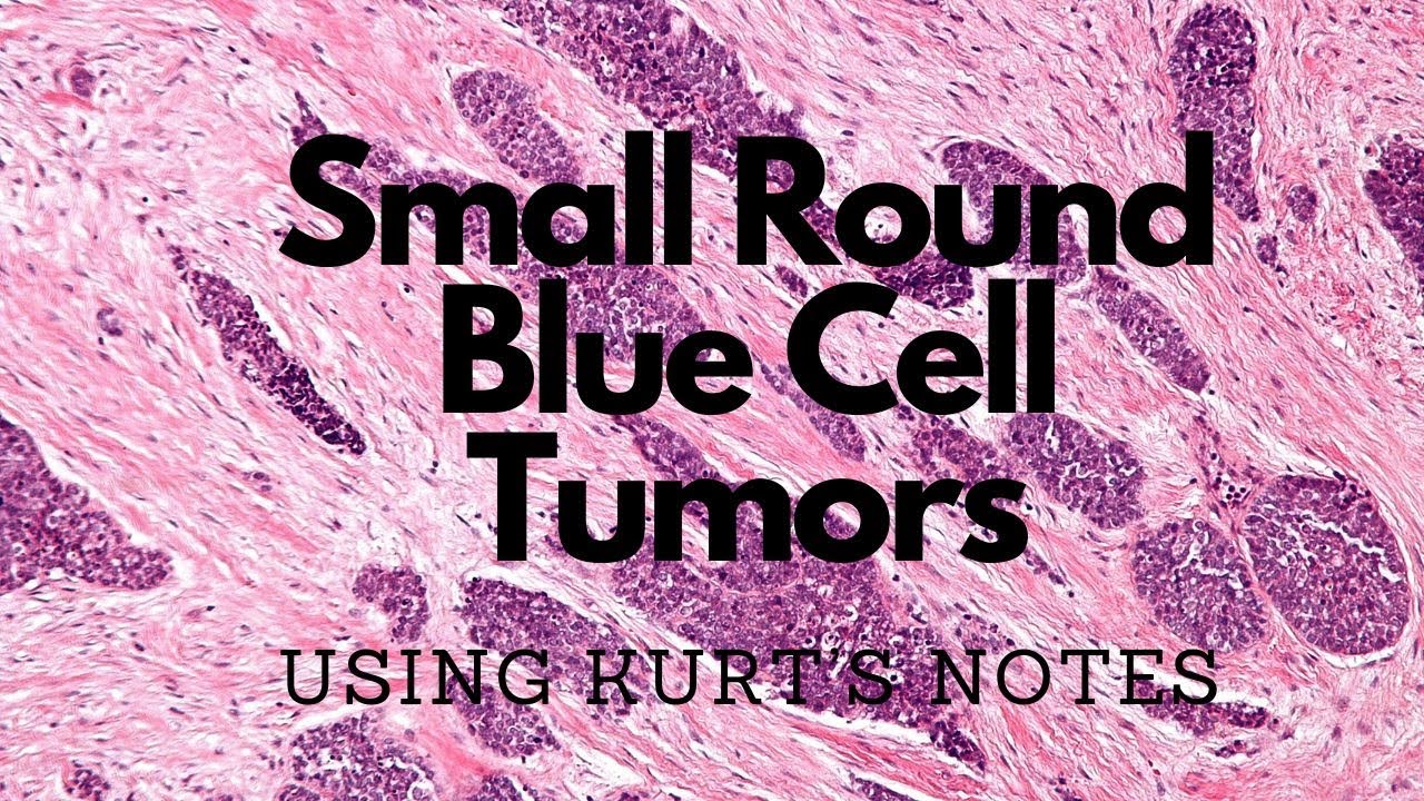 Small Round Blue Cell Tumor Ddx: Using Kurt&rsquo;s Notes #pathagonia