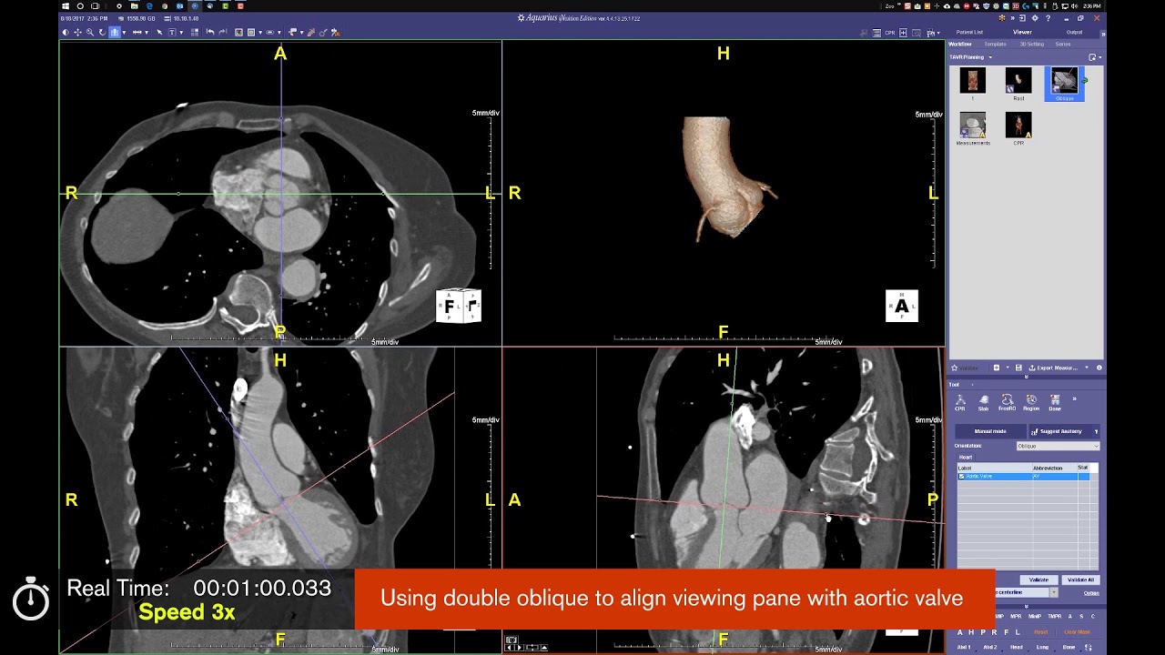 Intuition | TAVR Workflow