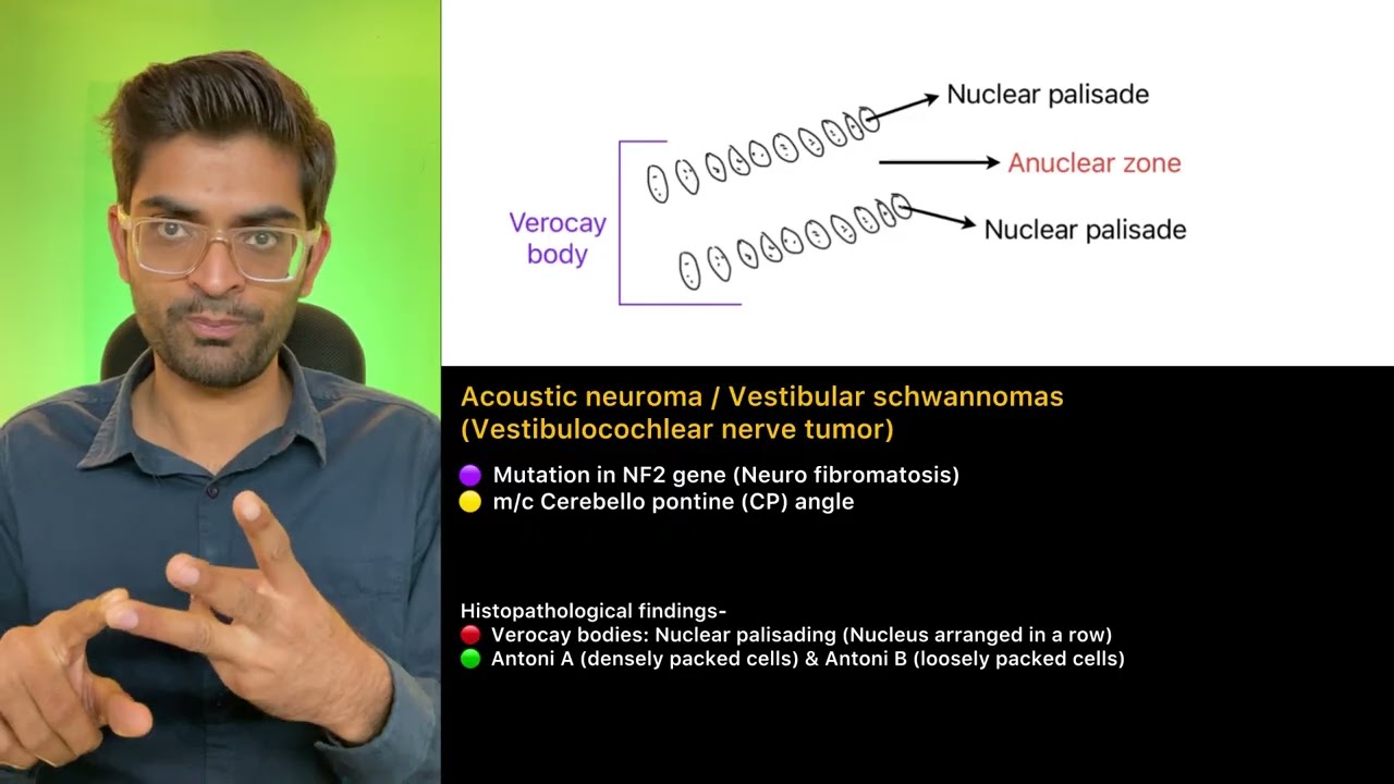 Acoustic neuroma / Vestibular schwanoma
