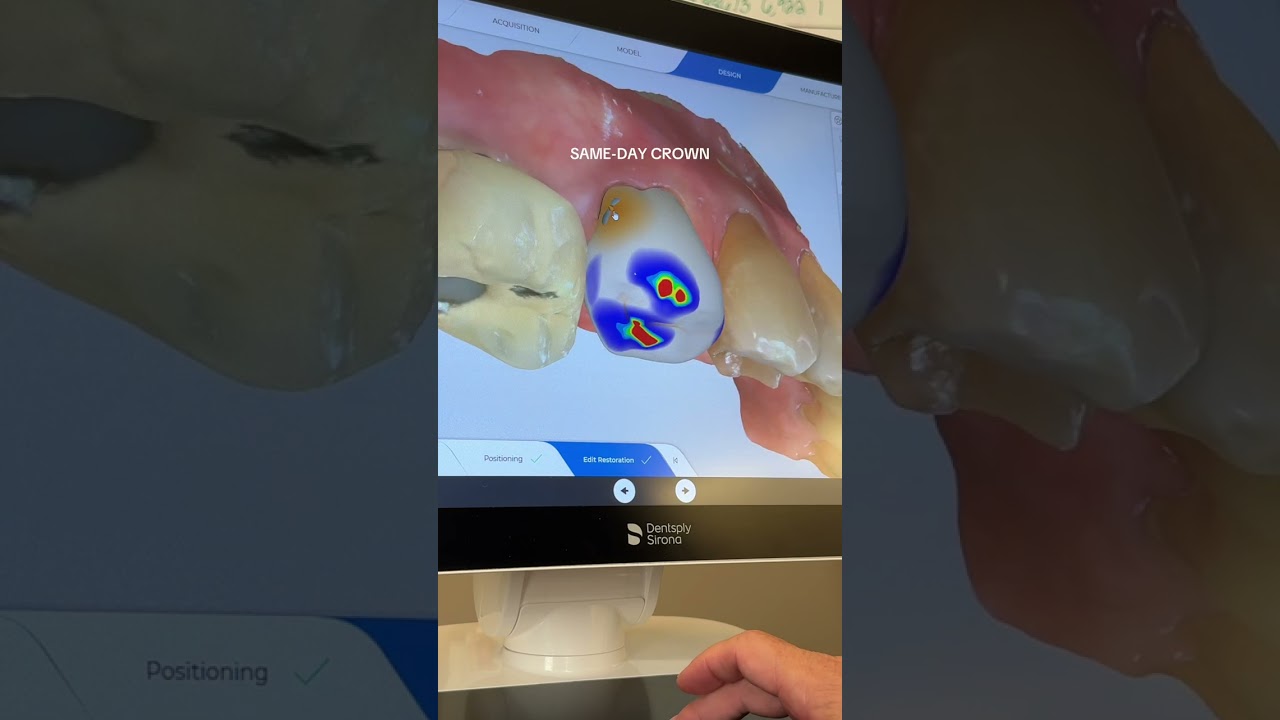 how we design a same-day crown, from start to finish, in one visit! #dentist #crown #cerec #design
