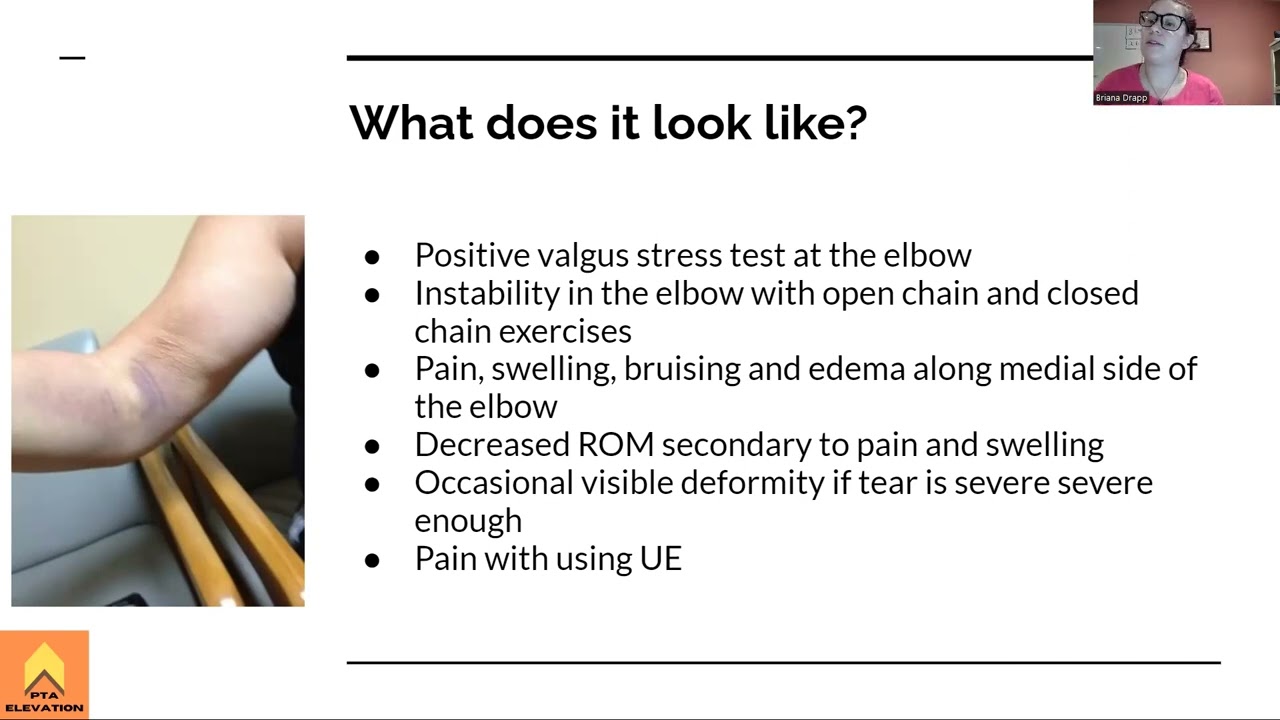 Ulnar Collateral Ligament Tear (Elbow) - NPTE Prep