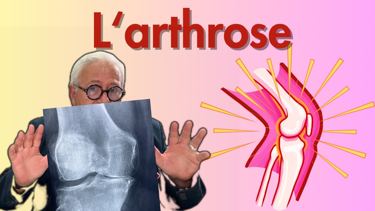 Arthrose: causes, lésions, signes, diagnostic, traitements