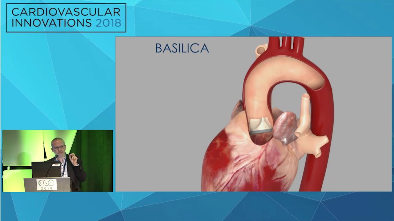 CVI2018 Session: Techniques to optimize transcatheter aortic therapy - Adam Greenbaum, MD