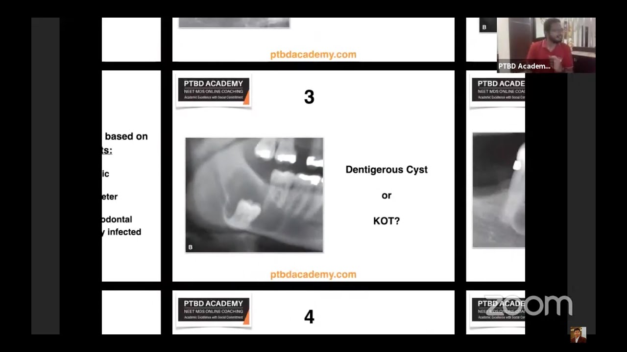 How To Identify Cysts On Radiographs? | Quick Revision Class