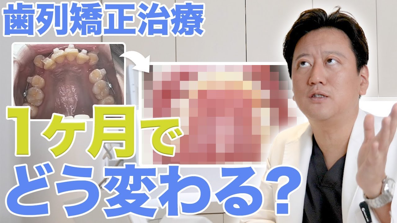 【歯列矯正】ワイヤー矯正、１ヶ月でどのくらい動く？ワイヤー交換のベストなタイミングは？【審美歯科 歯並び 歯医者】