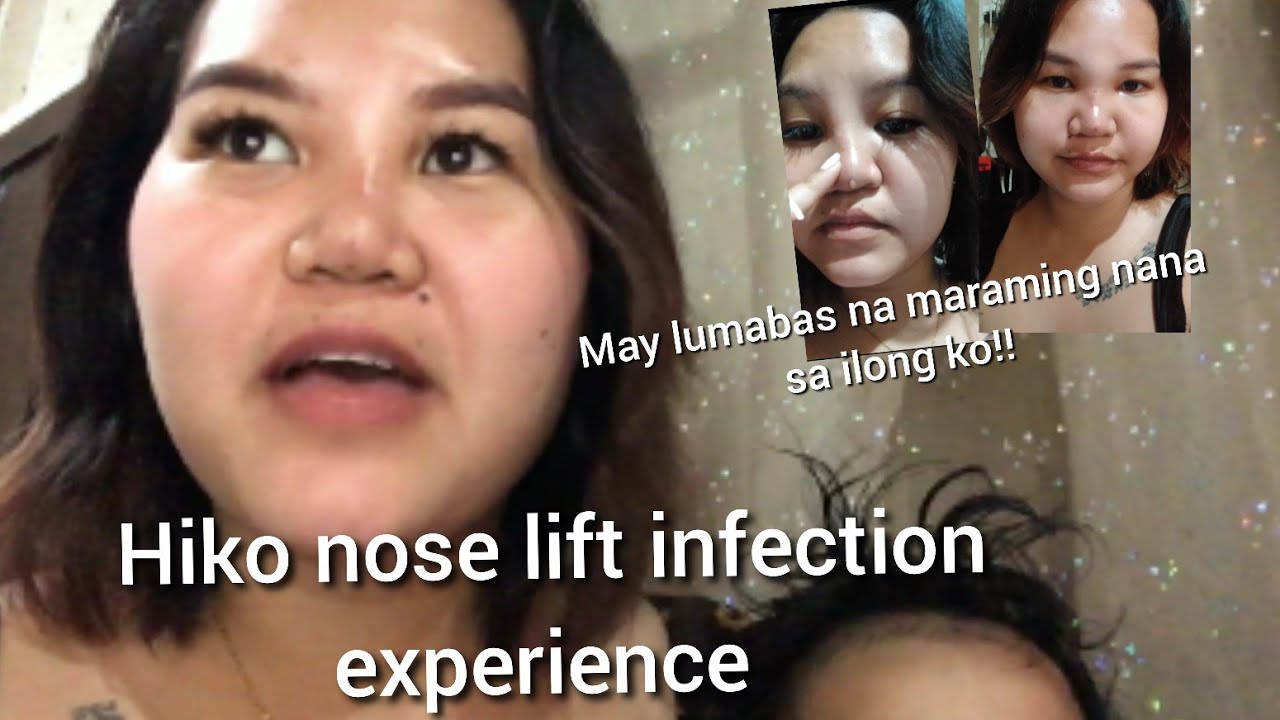 My Hiko nose lift got infected 