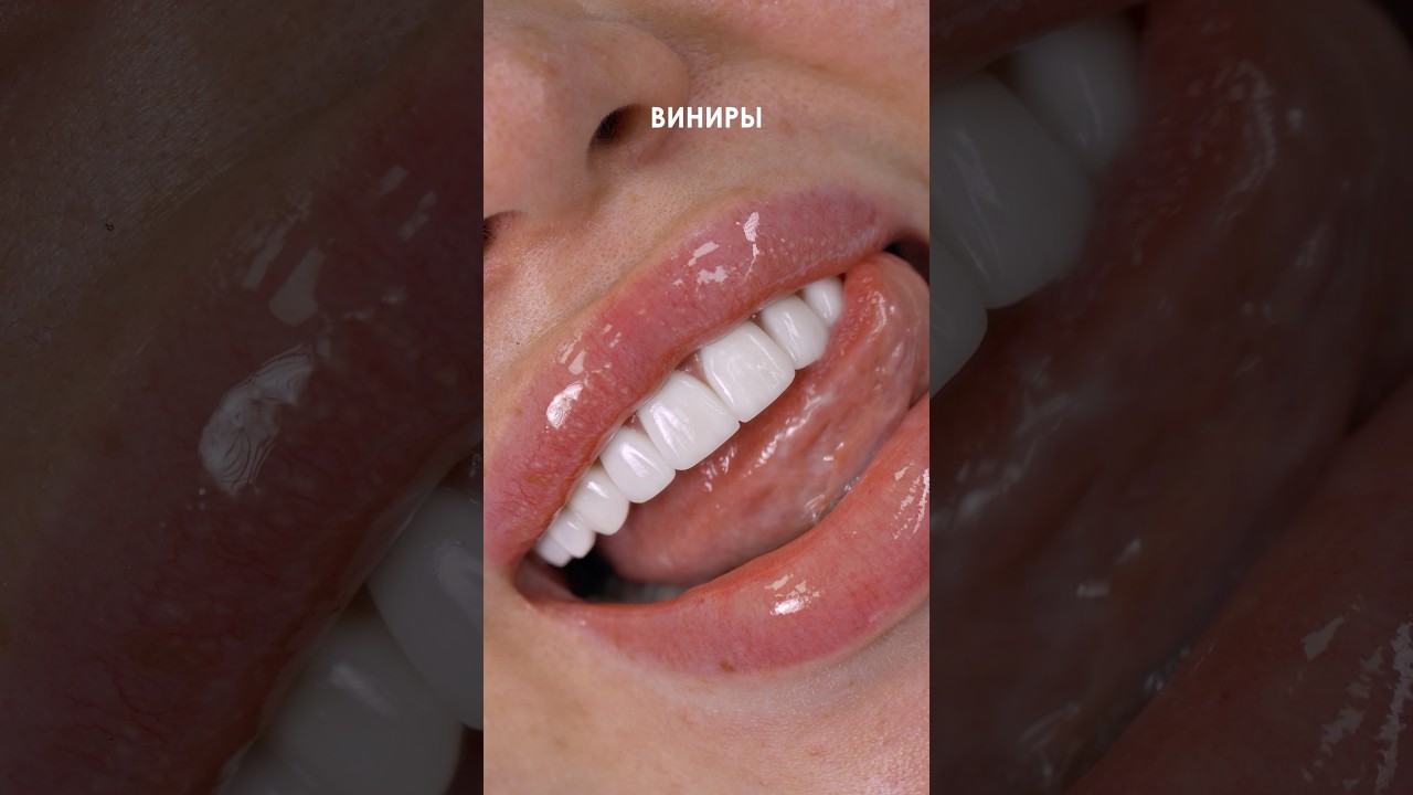 Виниры из ультратонкой керамики 16.990ru. Подробнее ТГ: 8969 0004040 Инста: yourclinic.ru
