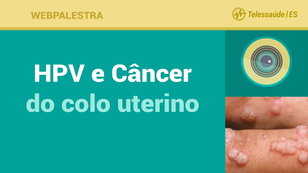 Webpalestra: HPV e Câncer do Colo Uterino - Telessaúde ES 15/09/2016