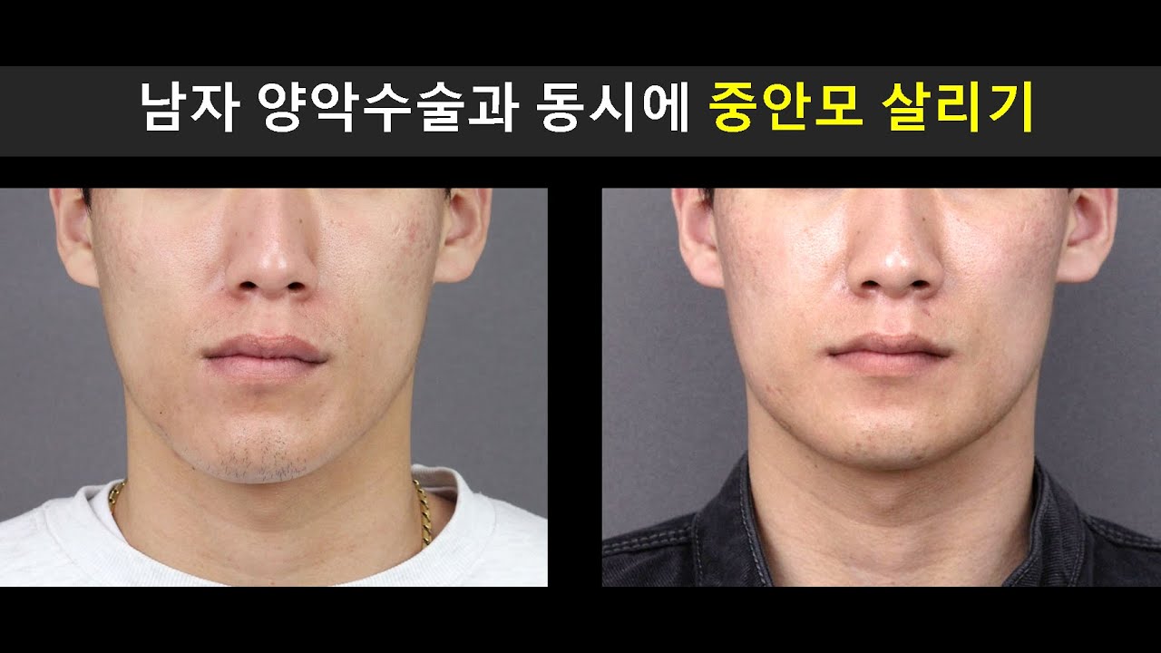 남자 양악수술과 동시에 중안모 살리기 ( Double Jaw Surgery with Midface Enhancement for Men)