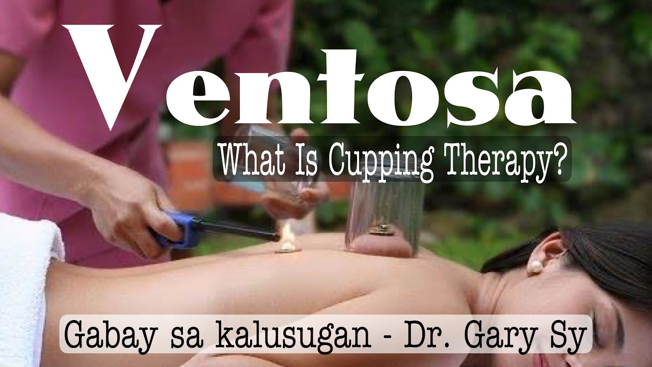 Ventosa (Cupping Therapy) - Dr. Gary Sy