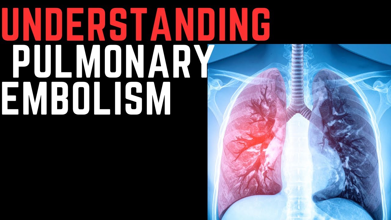 Pulmonary Embolism: If You Feel This, Call 911