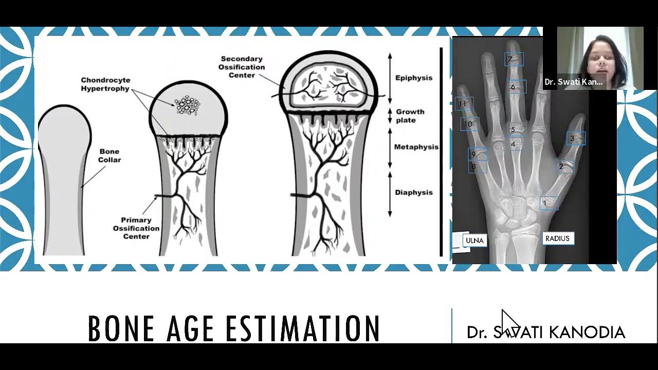 Bone age estimation :Dr Swati Kanodia