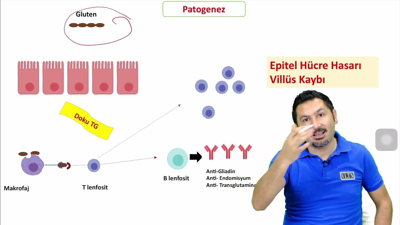 Çölyak Hastalığı. Patofizyoloji temelli anlatım. (DRPATOLOJI.COM)