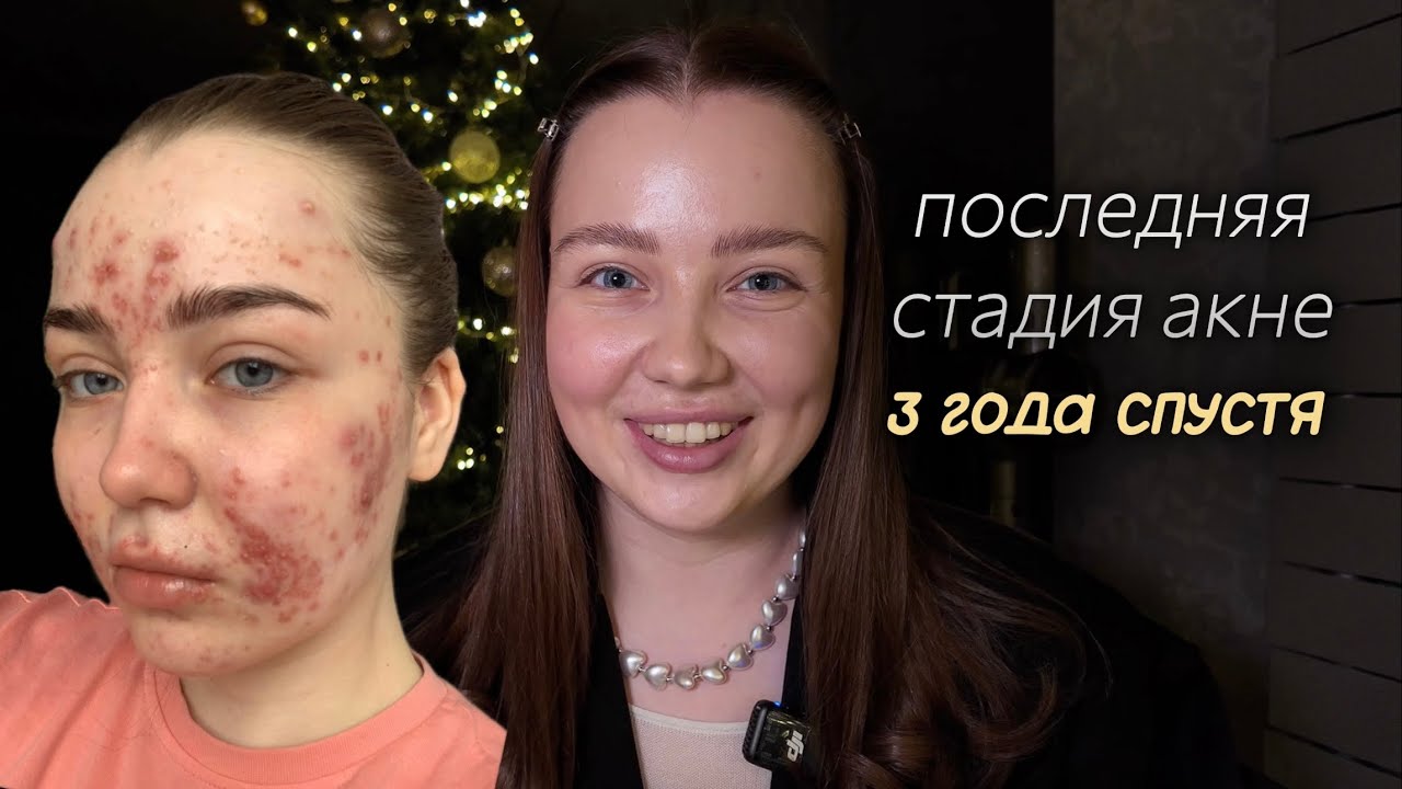 последняя стадия акне | как выглядит кожа спустя 3 года | побочки ретиноидов | случился ли рецидив?