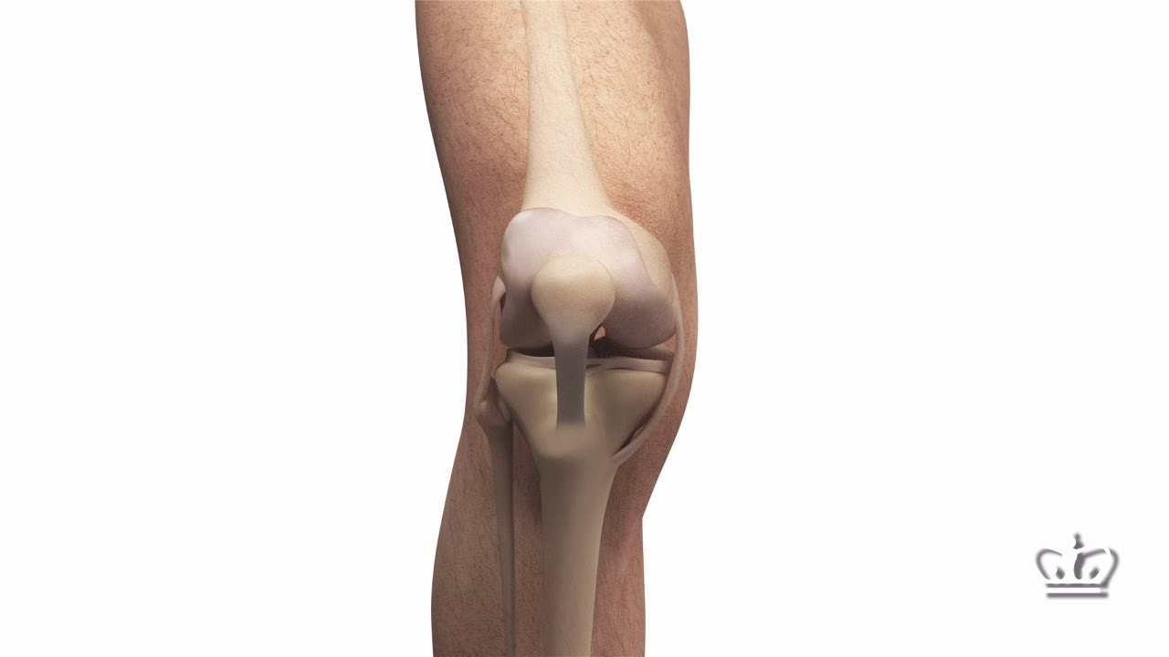 Knee Meniscus Regenerated with 3D-Printed Implant