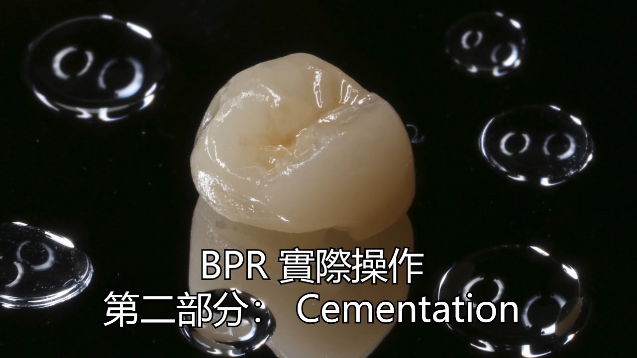 Bonded Porcelain(Partial) Restoration 實際操作part 2： Cementation