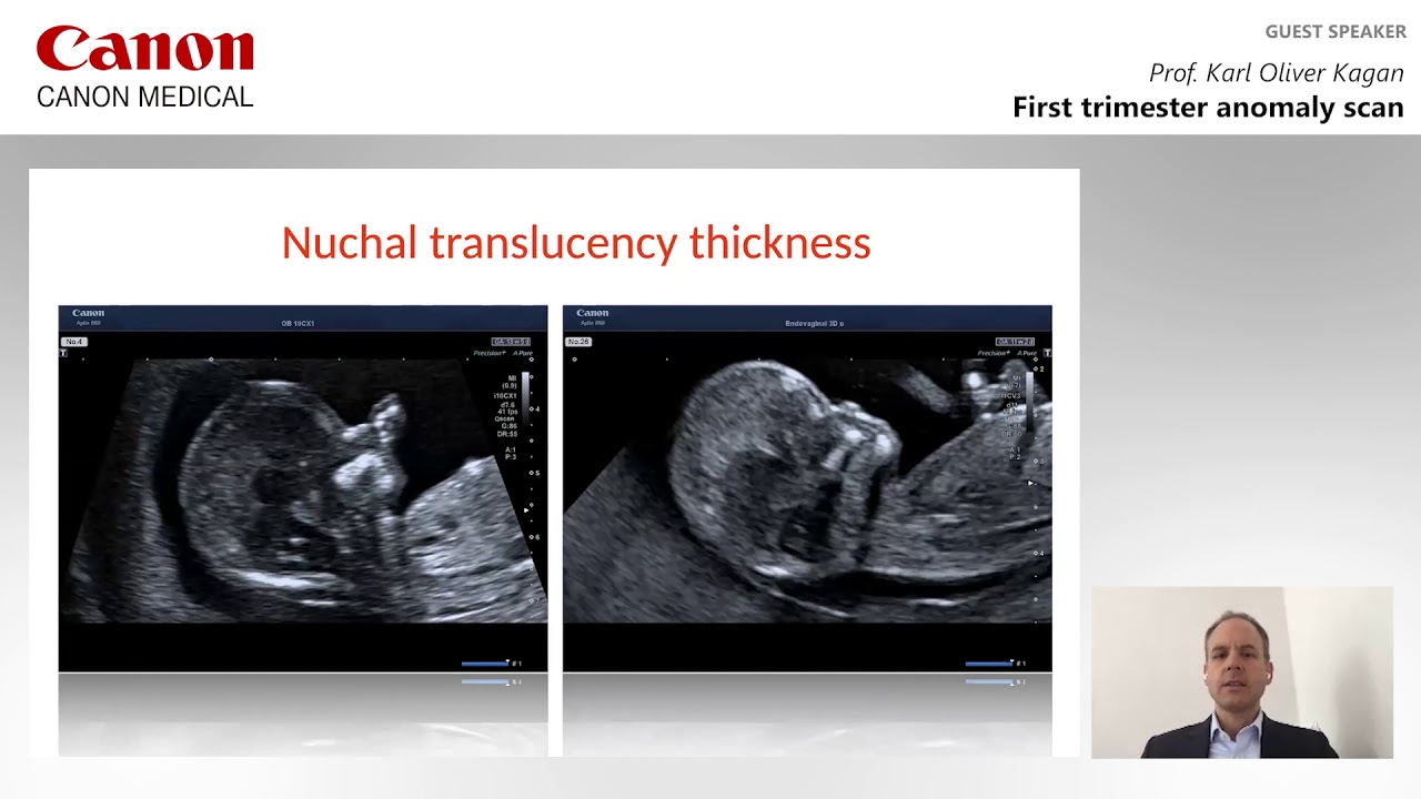 ISUOG 2020 Karl Oliver Kagan - First trimester anomaly scan