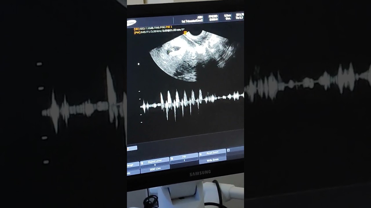 Hearing Baby's Heartbeat for the first time🥰🥰        7 weeks pregnancy ultrasound❤️ 