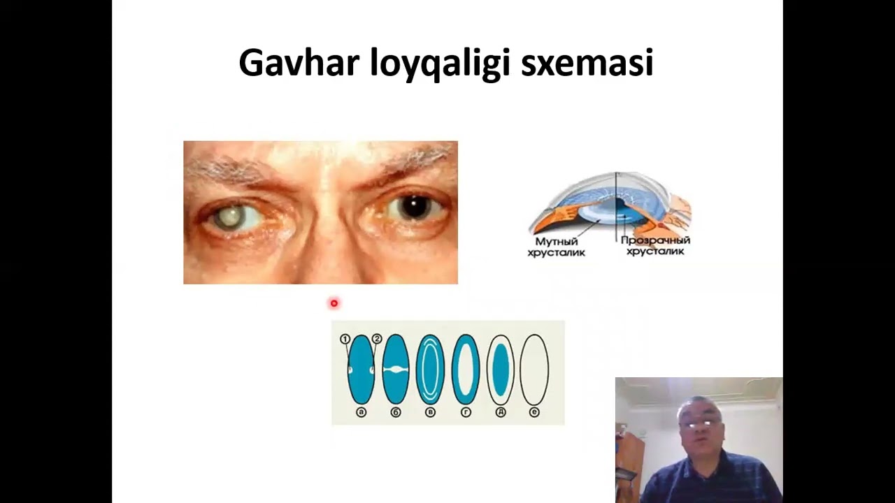 Gavhar kasaliklari