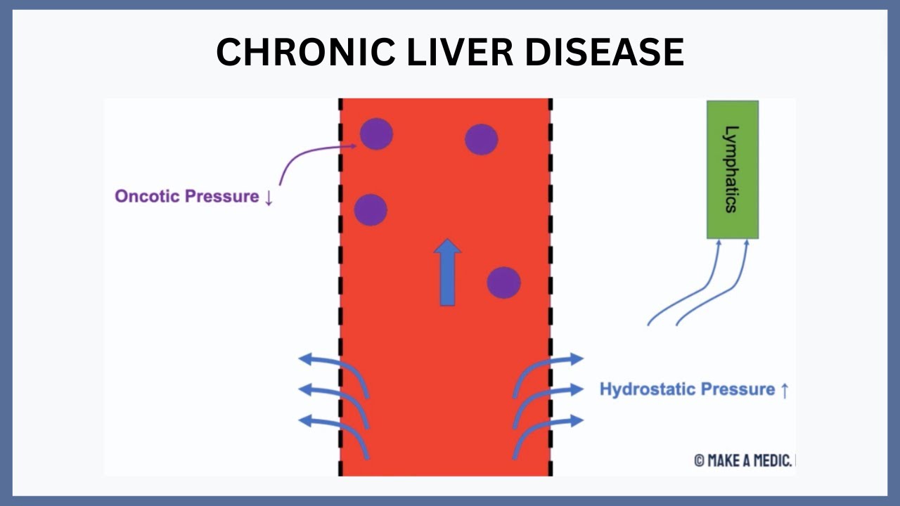 Chronic Liver Disease Explained