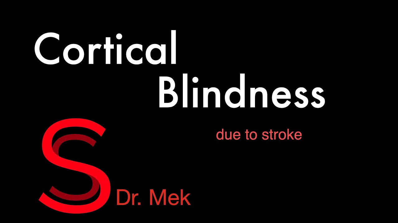 Strike Stroke with Dr. Mek: Cortical Blindness due to stroke. (E19)